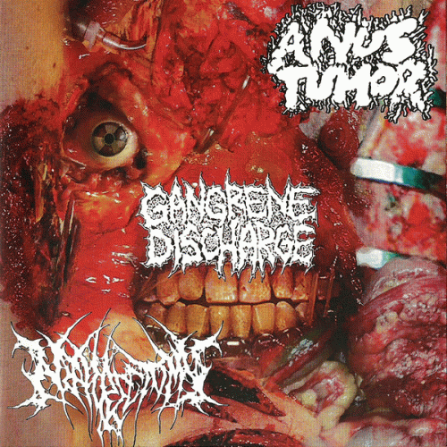 Nephrectomy : Anus Tumor - Nephrectomy - Gangrene Discharge